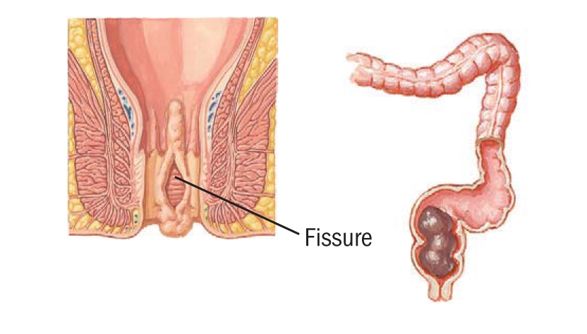 Constipation After Anal Sex 35